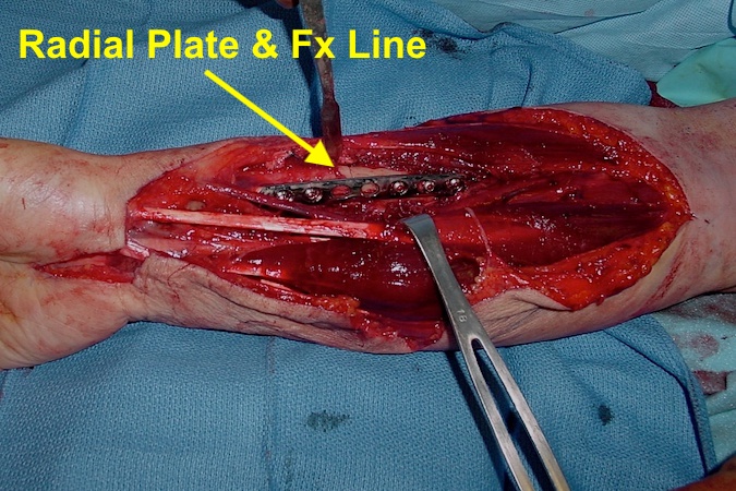 Right radial plate and compressed fracture line.