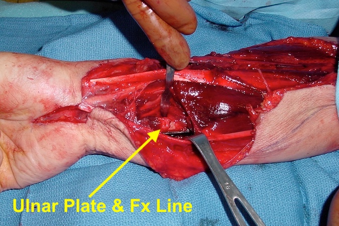 Right ulna plate and compressed fracture line.