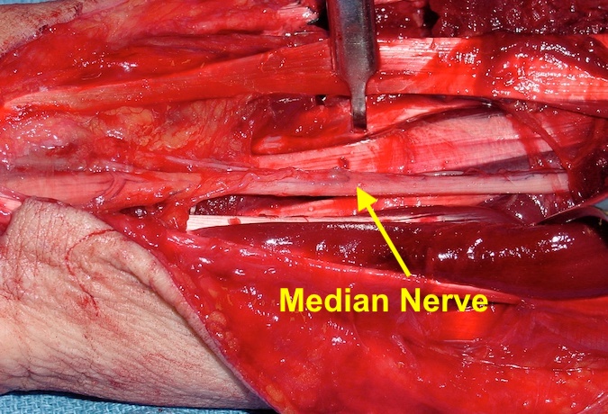 Wound after I&D and ORIF of both fractures.  Median nerve visible.