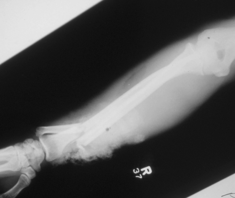 Lateral X-ray right open distal -third transverse radius and ulna fractures