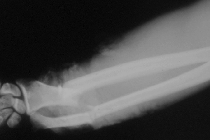 AP X-ray right open distal -third transverse radius and ulna fractures