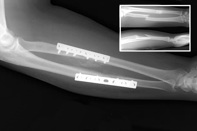 Left closed mid-third transverse radius and ulna fracture ORIF with 6 hole plate on radius and 7 hole plate on the ulna.