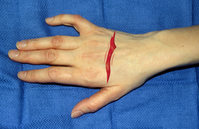 Dorsal laceration over right hand. Structures at Risk: 1. Skin; 2. Extensor Tendon-EDC; 3. Extensor Tendon- EDM; 4. Extensor Tendon- EIP; 5. Bone; 6. Dorsal Veins; 7. Dorsal Radial Sensory Nerve; 8. Dorsal Ulnar Sensory Nerve.  (Click on structure to see exam)