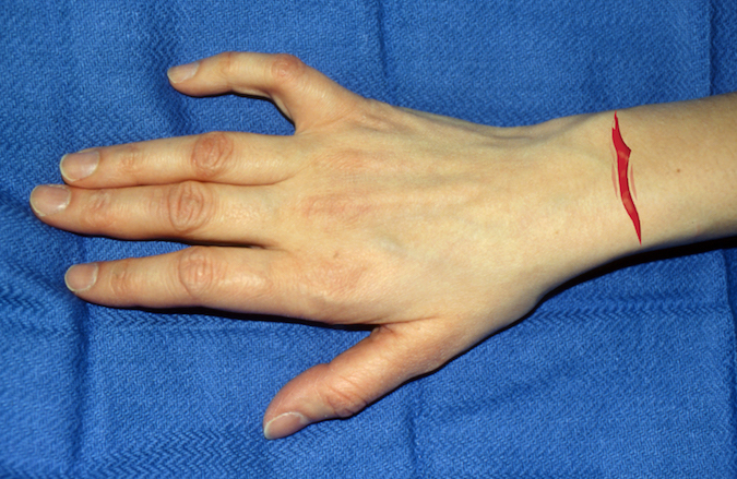 Dorsal laceration over distal right forearm. Structures at Risk: 1. Skin; 2. Extensor Tendons -EDU,ECM,EDC,EIP,EPL,ECRL&B, EPB&AbPL; 3. Wrist Joint; 4. Radius&Ulna Bones; 5. Dorsal Veins; 6. Dorsal Radial Sensory Nerve; 7. Dorsal Ulnar Sensory Nerve.  (Click on structure to see exam)