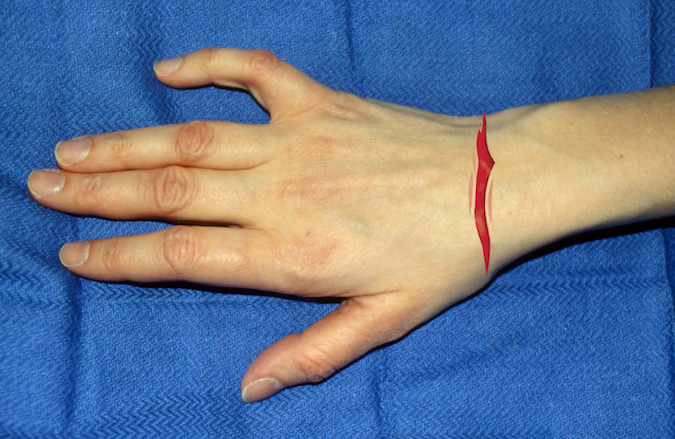 Dorsal laceration over right wrist. Structures at Risk: 1. Skin; 2. Extensor Tendons -EDU,ECM,EDC,EIP,EPL,ECRL&B, EPB&AbPL; 3. Wrist Joint; 4. Carpal Bones; 5. Dorsal Veins; 6. Dorsal Radial Sensory Nerve; 7. Dorsal Ulnar Sensory Nerve; 8. Radial Artery.  (Click on structure to see exam)