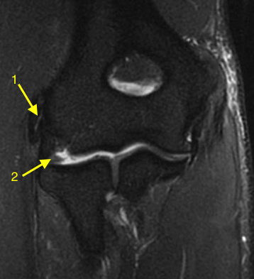 Lateral epicondylitis with intrasubstance tear in the extensor origin(1) and plica(2).