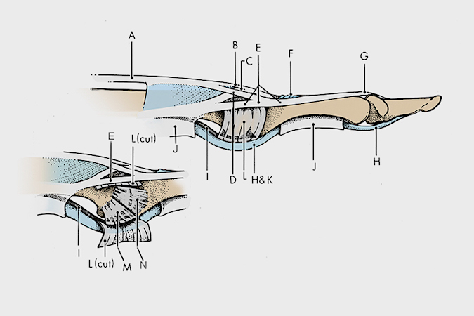 A. Extensor tendon; B. Central slip; C. Oblique fibers of dorsal aponeurosis; D. Lateral slip; E. Conjoined lateral band; F. Triangular ligament; G. Terminal extensor tendon; H. Flexor digitorum profundus; I. Volar plate; J. A-2 & A-4 pulleys; K. Flexor digitorum superficialis; L. Transverse retinaculum; M. Accessory collateral ligament; N. Proper collateral ligament. During a volar plate injury which can cause a swan neck deformity, the volar plate (I) detaches from the base of the middle phalanx.  A malle