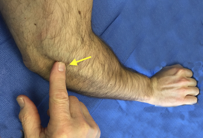 Point tenderness at the lateral epicondyle (arrow)