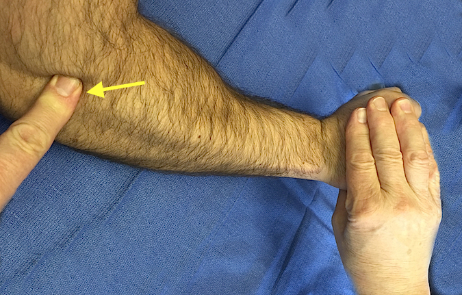 Point tenderness at the lateral epicondyle (arrow) made worse by resisted wrist dorsiflexion
