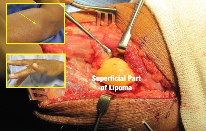 Lipoma with PIN nerve palsy.  Inserts show tip of lipoma in the proximal dorsal forearm and the partial PIN palsy on examination of the finger extension.