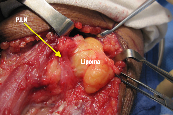 Lipoma with PIN nerve palsy.  The lesion and the PIN (posterior interosseous nerve) have been exposed through a dorsal Thompson approach.