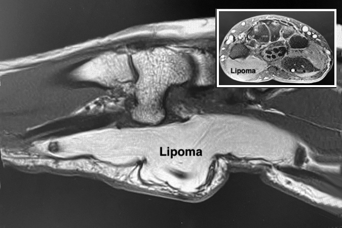 MRI of recurrent atypical lipoma of right hand and wrist (Guyon's Canal) with T1 sagittal view  and X-sectional view in insert.  Note MRI of benign and atypical lipomas have a similar appearance