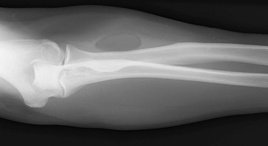 Note the radiolucent mass in the proximal radial forearm. Lipomas frequently appear darker on plain X-ray than the surrounding muscle. This radiographic finding is called a Bufalini Sign.