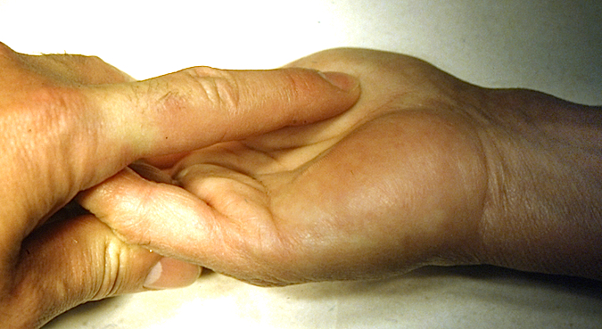 Palpating lipoma in carpal tunnel