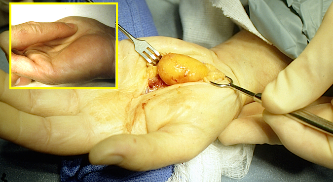 Excision of lipoma from the left carpal tunnel