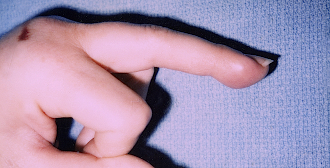 Lateral view of lipoma in fingertip