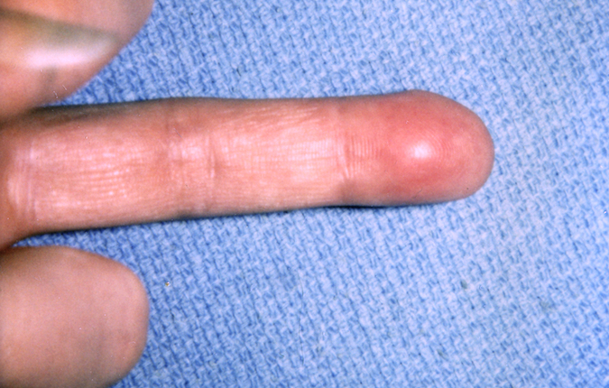 Palmar view of lipoma in fingertip