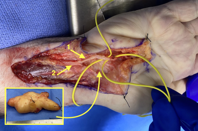 Recurrent atypical lipoma has been excised from left wrist and hand.  Excised tumor in the insert. Ulnar artery (1) and ulnar nerve (2) is shown.