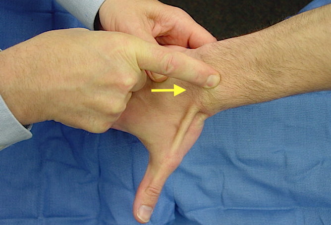 Lister's tubercle being palpated with arrow at S-L ligament location.