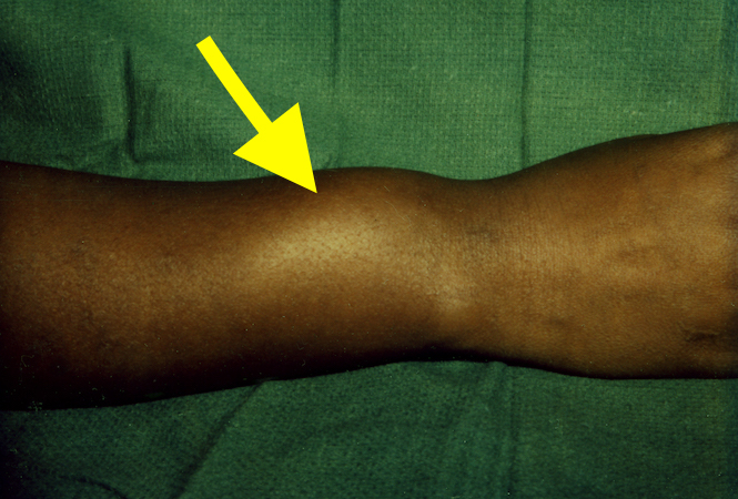 Lymphoma - Note swelling (arrow) in area of first extensor muscles