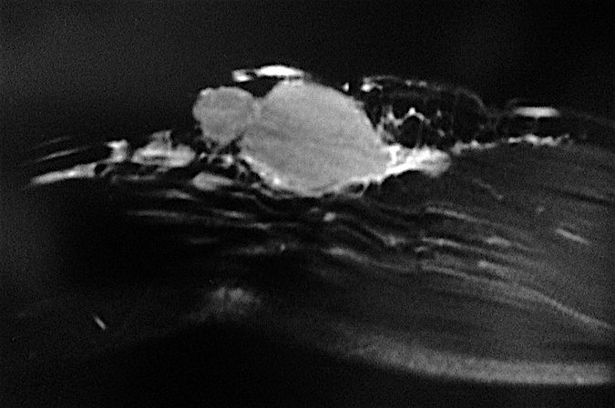 Lymphoma - Imaging study with mass in anterior medial elbow