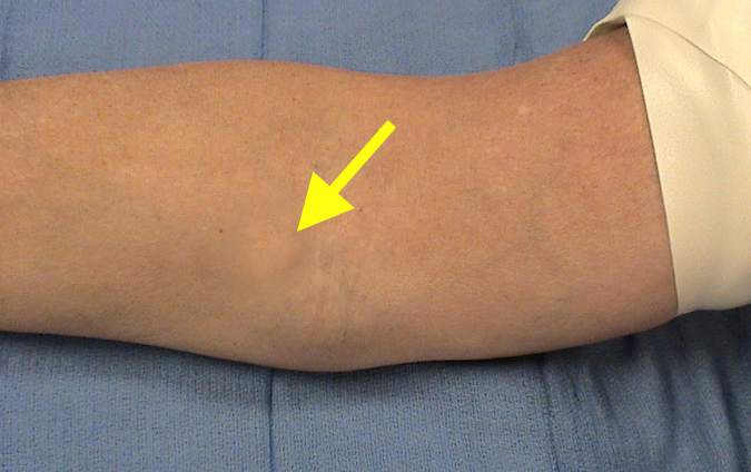 Lymphoma - Note swelling (arrow) in anterior medial elbow