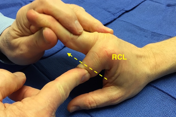Testing index MP joint  radial collateral ligament (RCL) after reduction of dislocation.  Force being applied in the direction of the  arrow.