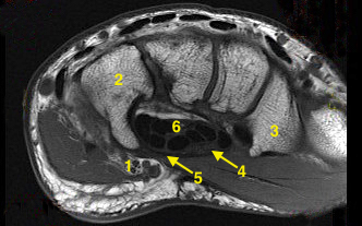 MRI showing cross section of carpal tunnel. 1.Ulnar nerve; 2.Hamate and hook of hamate; 3.Trapezium and trapezoidal ridge; 4.Median nerve; 5.Transverse carpal ligament; 6. Flexor tendons