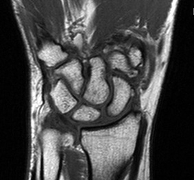 MRI Wrist T1