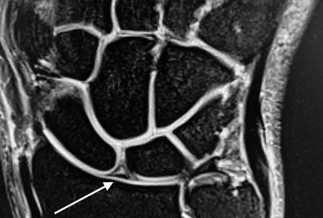 MRI T1 showing an intact SL ligament (arrow).