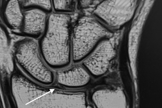MRI T2 showing an intact SL ligament (arrow).
