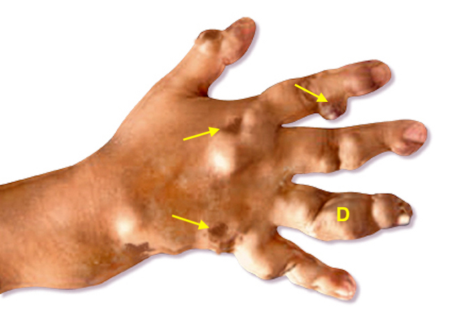 Classic graphic appearance of Maffucci's Syndrome with hemangiomatous skin changes (arrows) and skeletal deformities (D).
