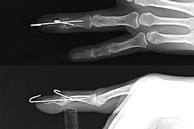 Mallet Finger Fracture (AP&Lat) after reduction and extension block pinning