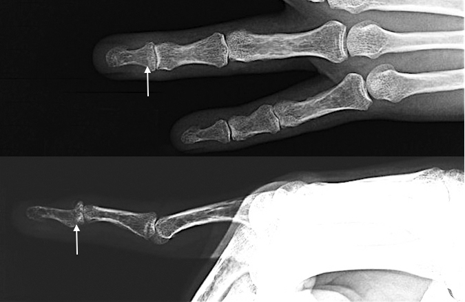 Mallet Finger Fracture at arrow  (AP&Lat) after healing and pin removal
