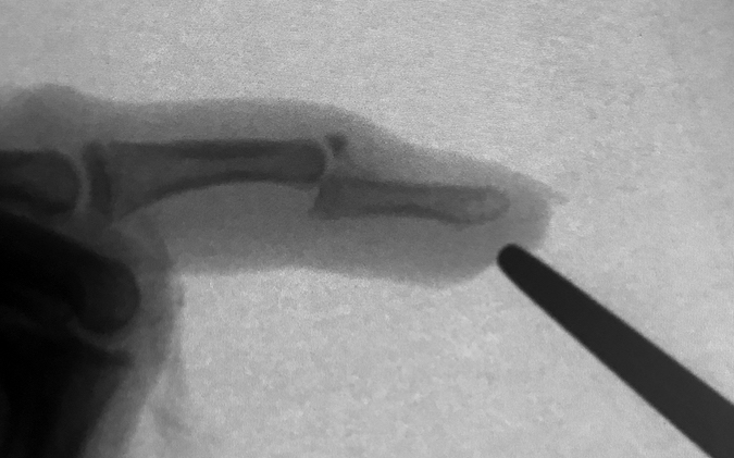 Mallet Finger Fracture with distal fragment subluxation. This fracture will require surgical treatment.