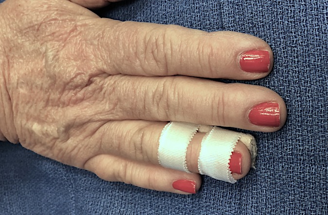 Palmar mallet finger splint for right ring finger