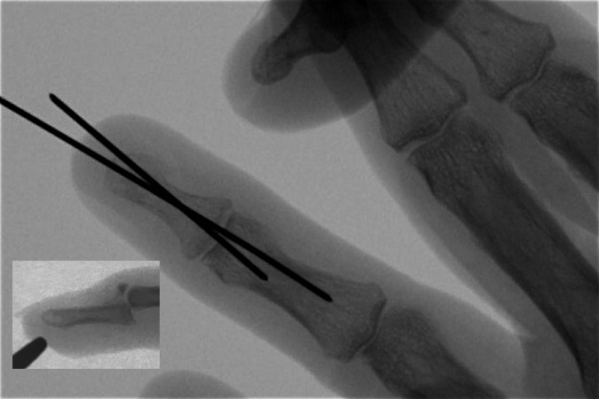 Mallet Finger Fracture with severe subluxation undergoing reduction with mini-fluoroscopy and percutaneous  extension block pinning.
