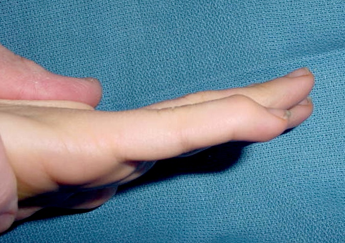 Mallet Finger Right Fifth - Note lack of extension at DIP joint