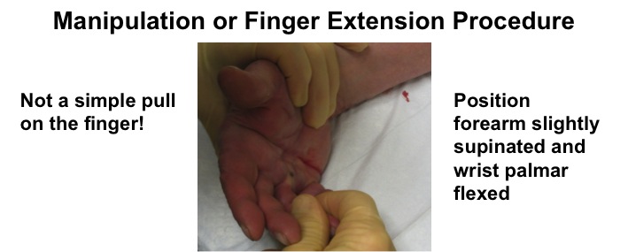 Forearm and wrist position for manipulation (finger extension) procedure