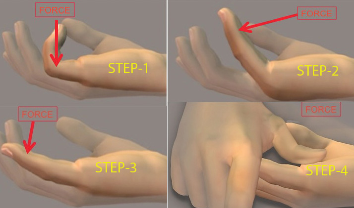 Four part manipulation technique to maximize cord disruption and minimize skin tears