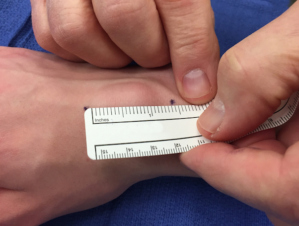 Measuring Dorsal Wrist Mass