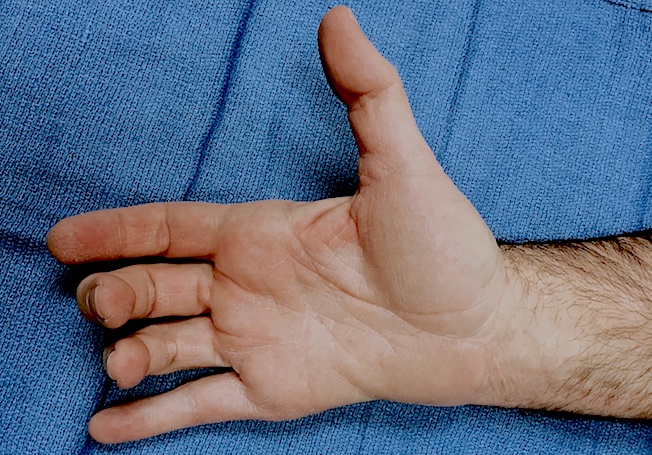 Masse's sign - flattening of the palmar arch secondary to hypothenar ulnar intrinsic muscle loss.