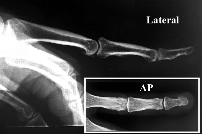 Normal X-ray left long finger from patient with a subungual melanoma.