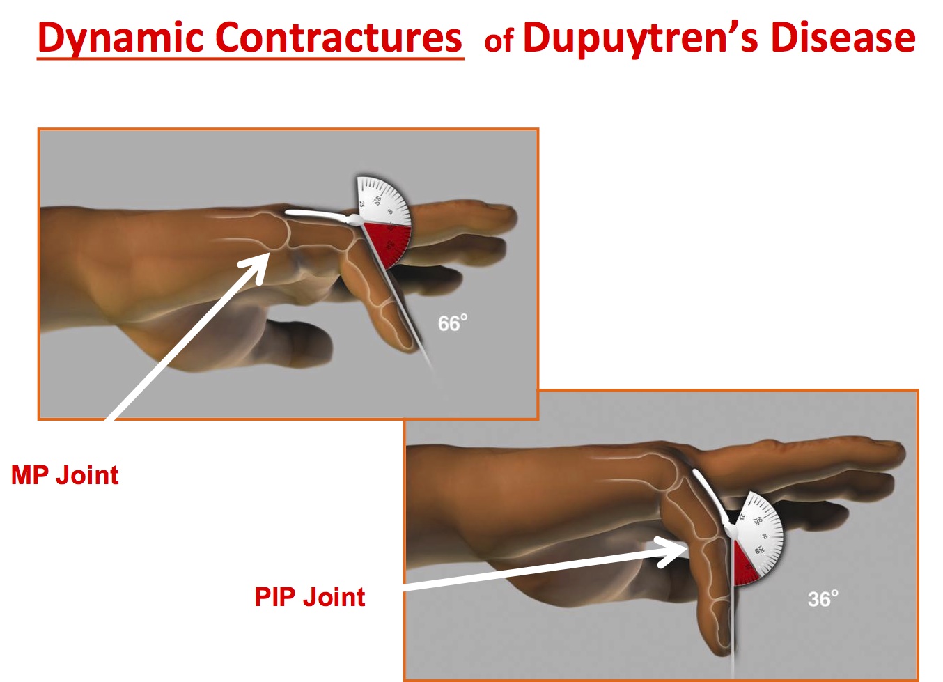Dupuytren's Disease -Clinical signs -joint contracture measurements. Note central cords cross two joints therefore the position of one joint influences the measurement of the FC in the other joint.