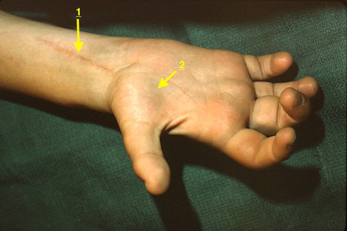 Chronic laceration Median Nerve (1) with thenar atrophy and flattened palmar arch (2).