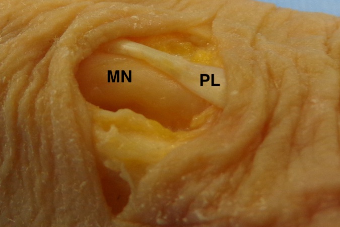 Median Nerve (MN) with palmaris longs (PL) resting on its palmar surface.