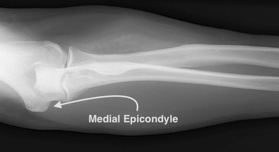 In golfer's elbow the X-ray of the elbow is usually normal. Occasional calcifications of the flexor origin will be seen.