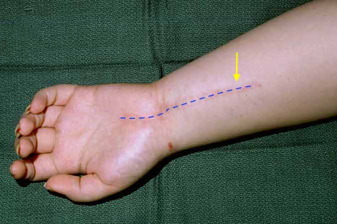 Eleven months after excision of a benign neurofibromatous hemangiomatous hamartoma,  this patient developed a recurrent mass (arrow), pain and had no signs of median nerve regeneration.