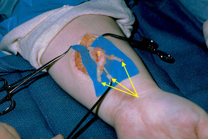 A year after excision of a benign neurofibromatous hemangiomatous hamartoma was re-explored.  The nerve grafts (arrows) were non-functional and the benign tumor (T) had recurred proximally.  Re-excision was done.  The median nerve function was lost but the pain resolved and long term follow-up showed no recurrence.