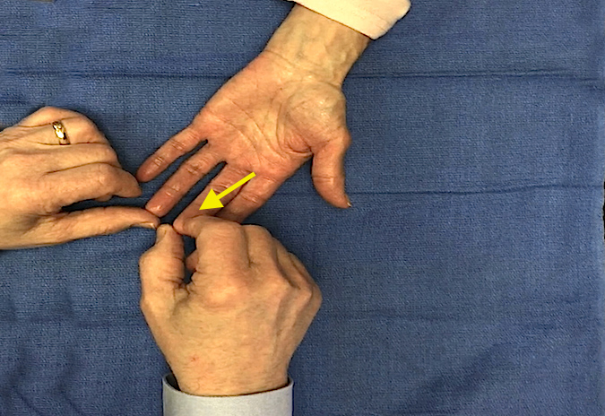 Median nerve sensation being tested at tip of long finger (arrow).
